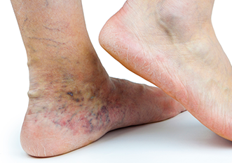 Enfermedad vascular periférica